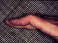 Even minor <b>tendon injuries</b> can