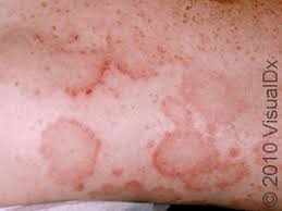 Image result for tinea corporis
