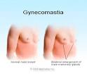 Occasionally, <b>gynecomastia</b>