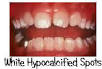 http://www.pediatricdentistsf.com/images/faq_dd_hypo1.jpg
