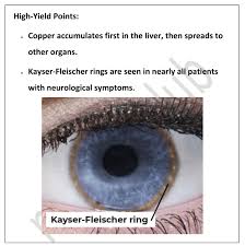 Kuvahaun tulos haulle Kayser-Fleischer