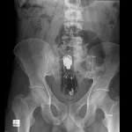 Rectal <b>foreign body</b> | Image | Radiopaedia.
