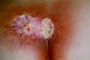 <b>Radiation Injury</b>: Fact