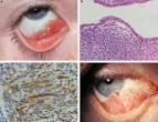 Eye - Figure 1 for article: Conjunctival rhabdomyosarcoma