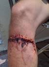 Motorcycle Leg Degloving Injury: Motorcycle Degloving Injury ...
