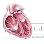 search Ventricular tachycardia from www.hopkinsmedicine.org