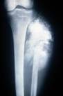 <b>Osteosarcoma</b> extending into