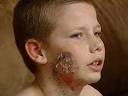 Burned: James Whalen, 12, was left with third-degree burns when he awoke on ... - b7d30120e46636e2_1