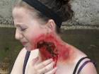 Necrotizing fasciitis by