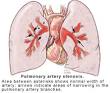 <b>Pulmonary artery</b> stenosis