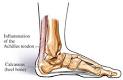 Achilles <b>Tendinopathy</b> — UVA Health