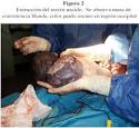 Los <b>encefaloceles</b> occipitales