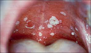 cura de candida albicans