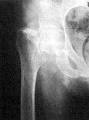 <b>Fractura</b> subcapital de cuello