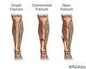 Bone fracture repair - series: MedlinePlus Medical Encyclopedia