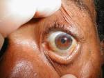 Muddy Brown <b>Sclera</b>: Brownish