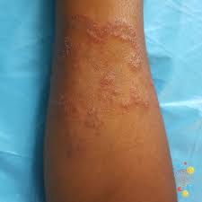 Image result for tinea corporis