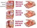 Hastamiyim.Net » Yanık Dereceleri ve Tedavi Yöntemleri