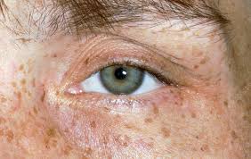 Kuvahaun tulos haulle Kayser-Fleischer