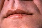 Cold Sores Pictures 1 (Hardin MD / CDC)