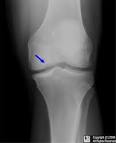 <b>Osteochondritis dissecans</b>.