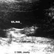 Attēlu rezultāti vaicājumam “Diderma umbilicatum young”