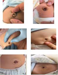 Attēlu rezultāti vaicājumam “Diderma umbilicatum young”