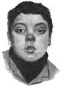<b>Facies</b> of Inherited Syphilis.