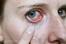 <b>eye infections</b> types