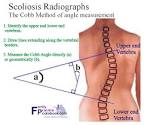 Nonstructural <b>Scoliosis</b>