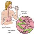 digestive system disorders: Urea breath test - Diagnosing H pylori ...