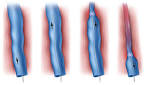 Endovenous Laser Treatment of Varicose Veins (EVLT) - Medrehab