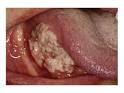 <b>Tumeur</b> à la <b>langue</b> - Cancer de