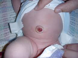 Attēlu rezultāti vaicājumam “Diderma umbilicatum stalked”