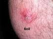 Boils Groin