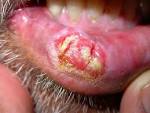 Dermatology - <b>LIP</b>: <b>carcinoma</b>