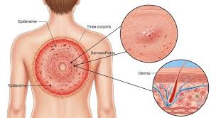 Image result for tinea corporis