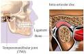 <b>Síndrome</b> de <b>la Articulación Temporomandibular</b> (TMJ por sus siglas