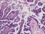 <b>Papillary carcinoma</b> of the