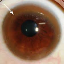 Kuvahaun tulos haulle Kayser-Fleischer