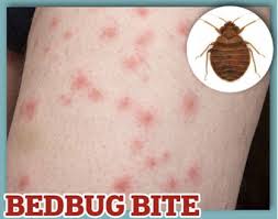 Image result for bed bug bites