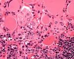 My approach to oncocytic tumours of the thyroid -- Asa 57 (3): 225 ...