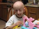 affected by Progeria are