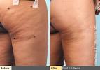 Cellulaze New Jersey Plastic Surgery