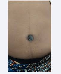 Attēlu rezultāti vaicājumam “Diderma umbilicatum young”