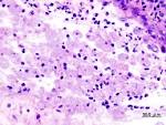 File:Amoebic dysentery in colon biopsy (1).jpg - Wikipedia, the ...