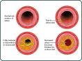 CDC - DHDSP - Heart Disease - Coronary Artery Disease