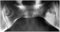 the <b>acquired hyperostosis</b>