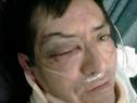 Mexican immigrant Alejandro Galindo's eye socket was shattered by ... - galindojpg-0967e3e178660657_large