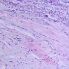 File:Eosinophilic myocarditis HE stain.jpg - Wikipedia, the free ...